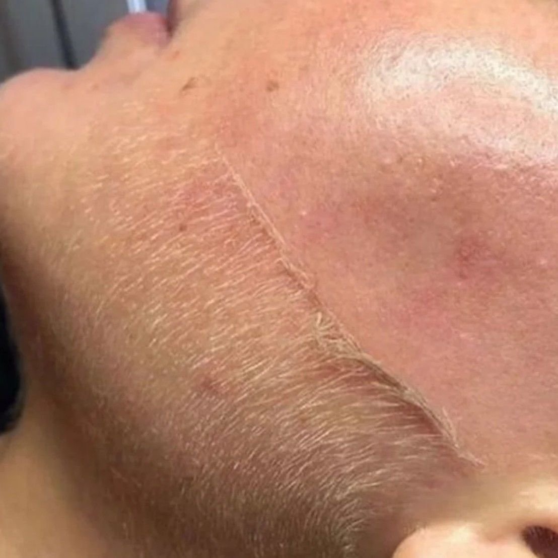 Dermaplaning